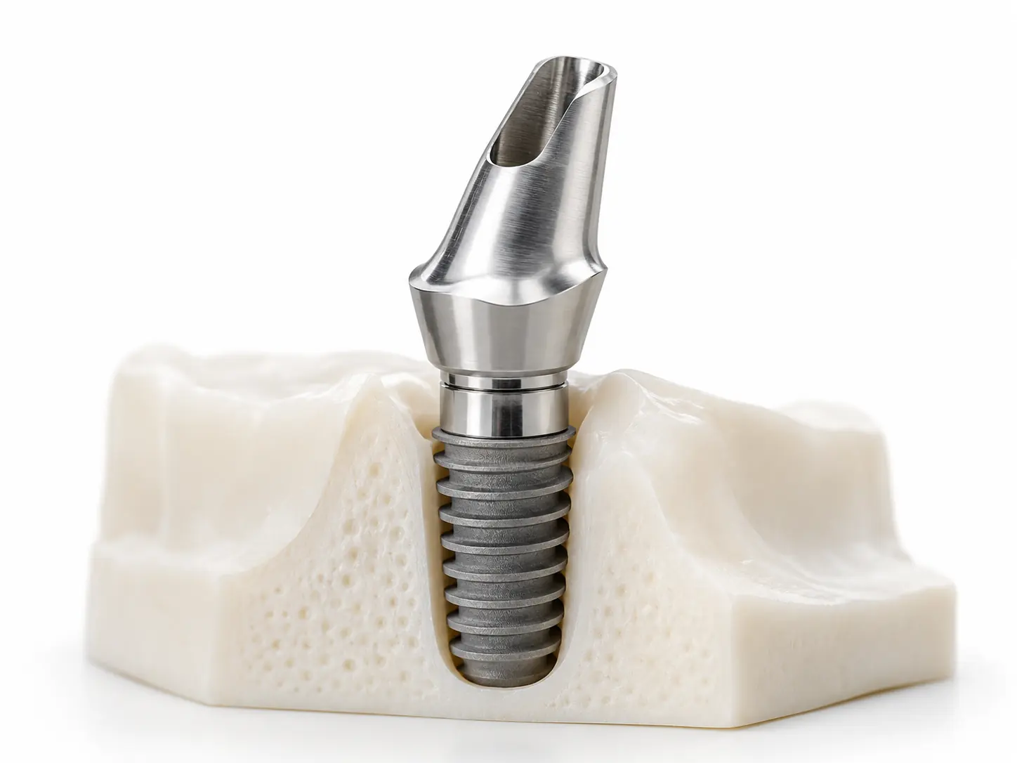 Dental product illustration of custom abutments