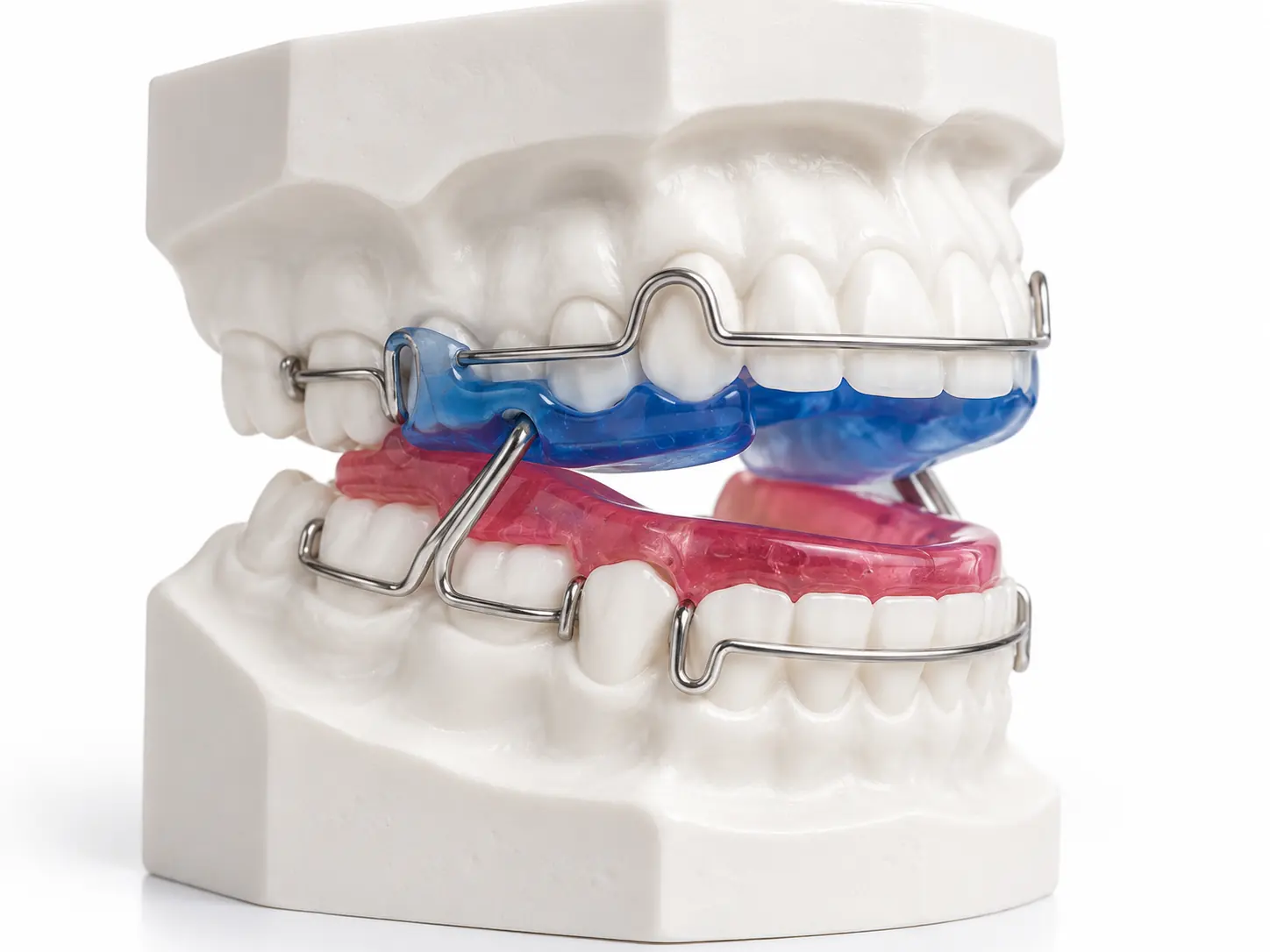 Dental product illustration of orthodontic custom appliances