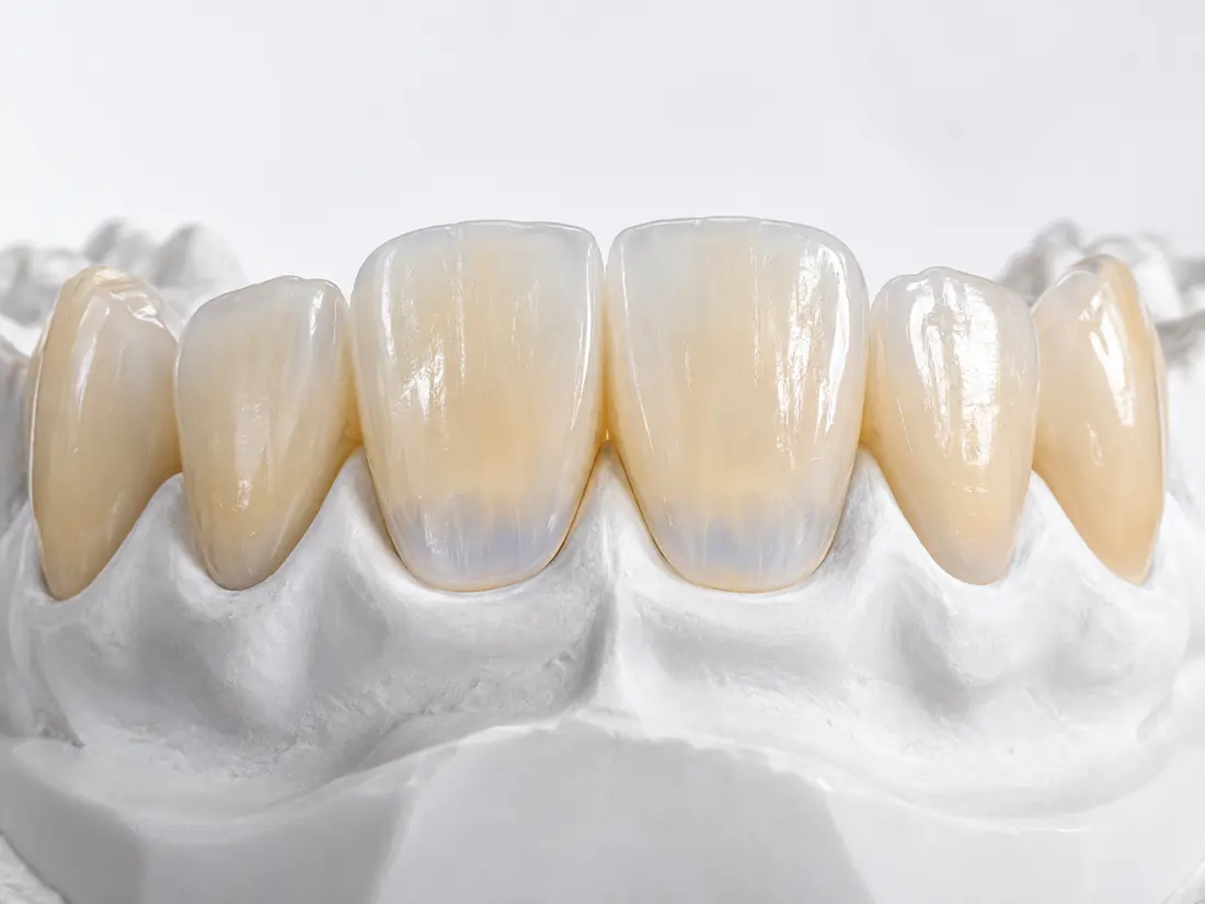 Dental product illustration of layered zirconia restorations
