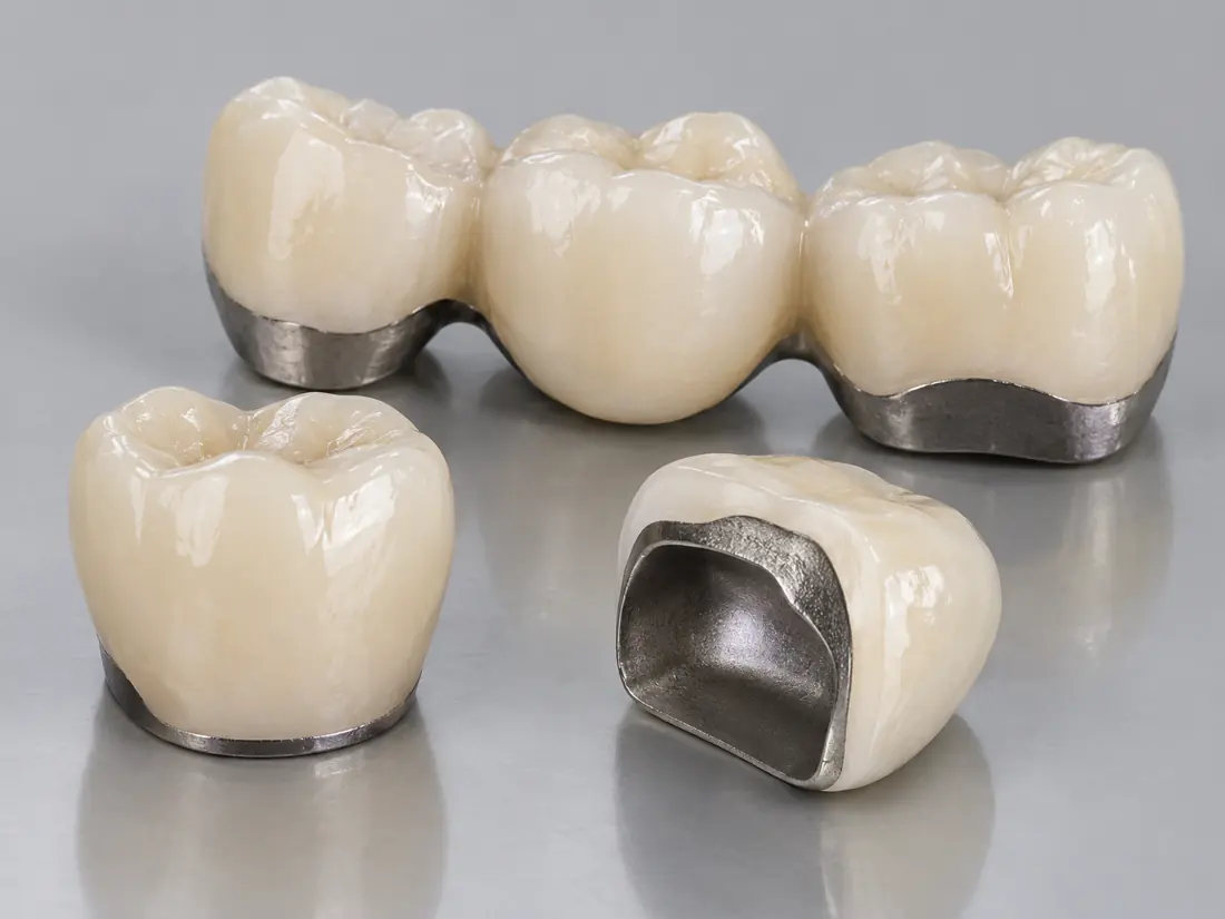 Dental product illustration of pfm crowns & bridges