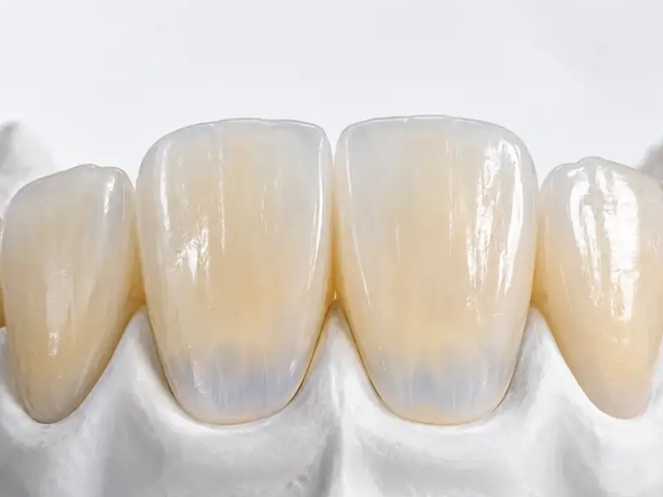 Incisal translucency focus