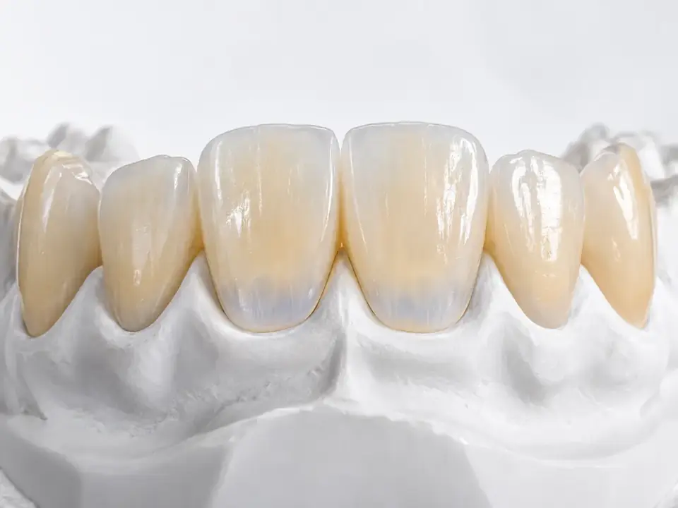 Layered anterior restorations