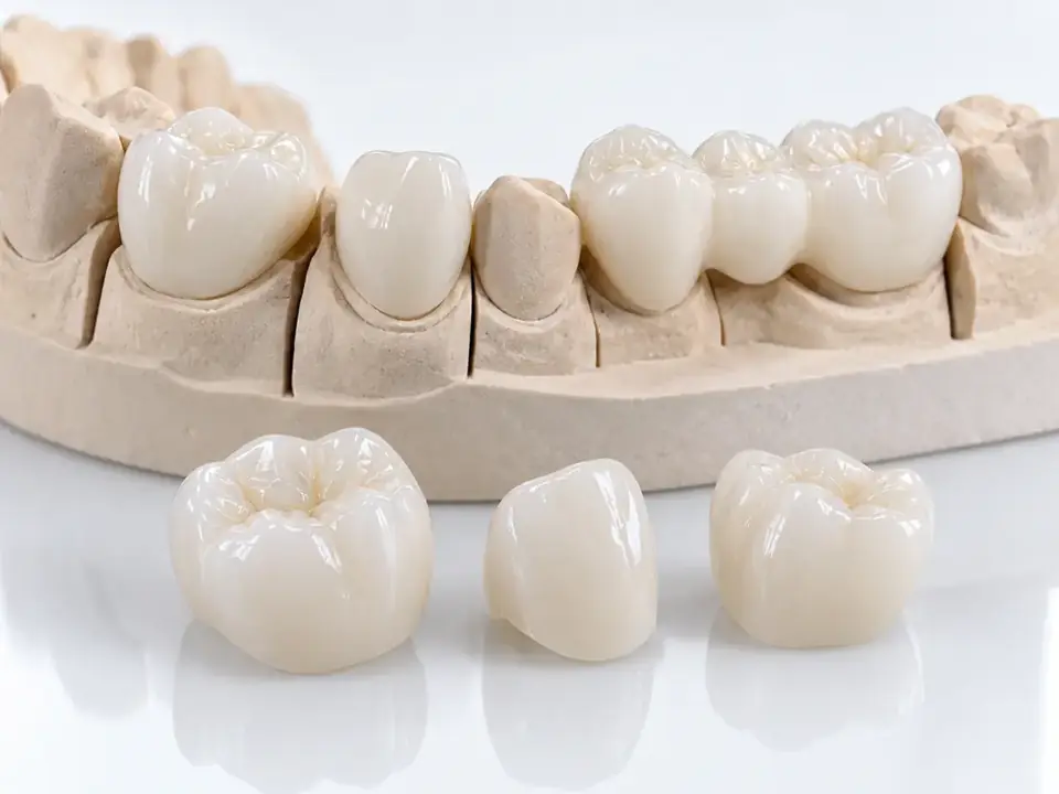 Full contour zirconia example